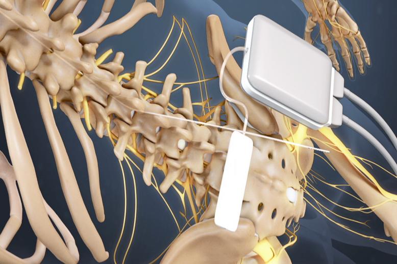 abbott spinal cord stimulator video